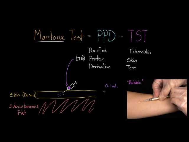 Mantoux Test (aka. PPD or TST)