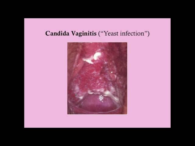 Infectious Vaginitis - CRASH! Medical Review Series