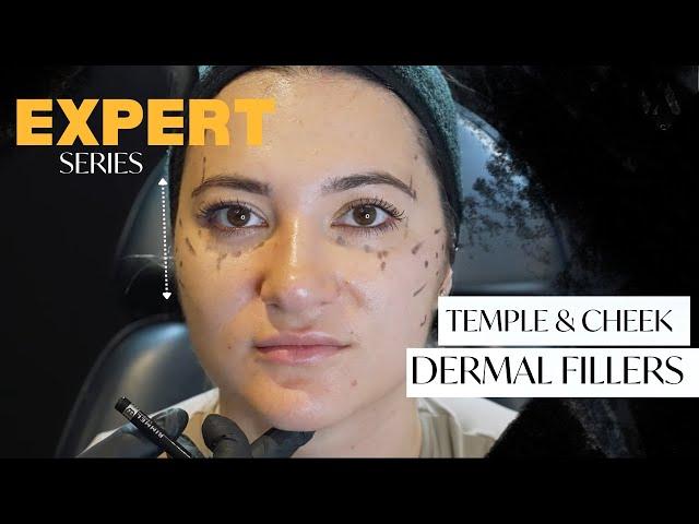 Temple and Cheek Dermal Fillers Treatment | Expert BTS 2023