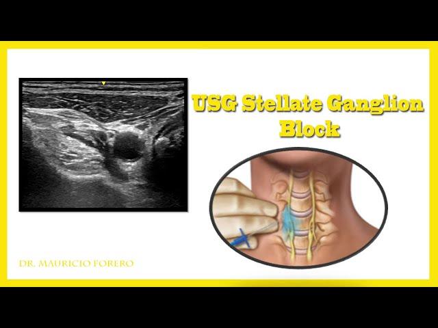 USG Stellate Ganglion Block