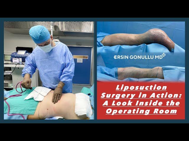 Liposuction Surgery in Action: A Look Inside the Operating Room | Plastic Surgery