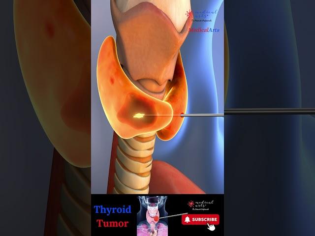 Goiter ※ Thyroid Tumor Radiofrequency Ablation ┬┬ RFA