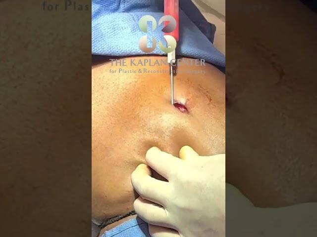Creating a New Belly Button - The Kaplan Center -  NYC NJ #bellybutton #bodycontouring