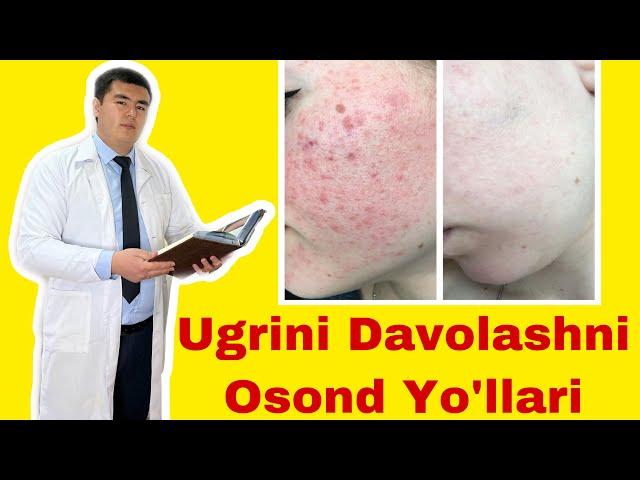 Ugrini Davolashni Osond Yo’llari | Husunbuzar Davosi | Uy sharoitida davolash