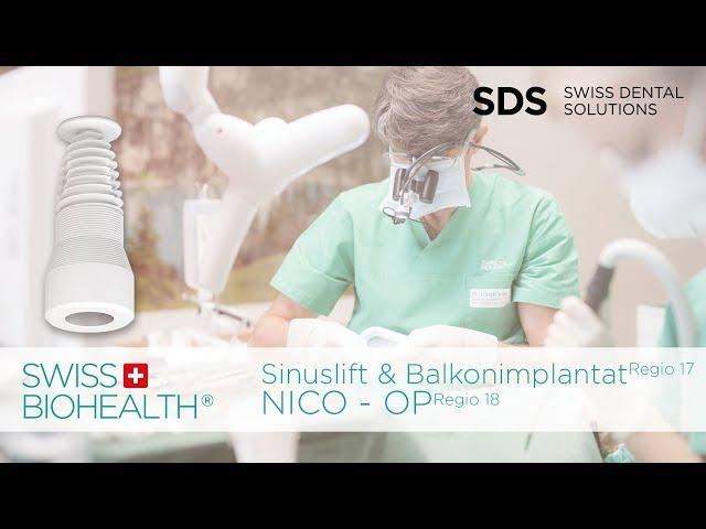 Interner Sinuslift und Balkonimplantat Regio 17 / NICO-OP in Regio 18