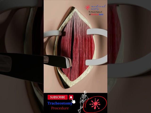 Tracheostomy procedure 🫁 tracheotomy surgery Annotated Version. #medicalanimation