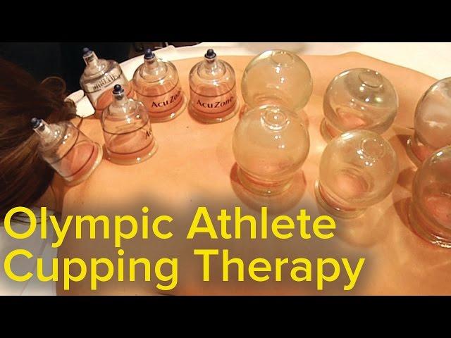 Chinese Cupping Therapy - Michael Phelps Olympics Bruise Mystery Solved | Pain Relief and Therapy