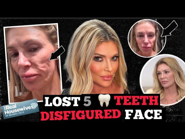 Brandi Glanville Claims Parasite Is Jumping Around In Her Face…lost 5 teeth