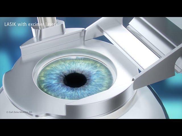 LASIK Treatment Animation