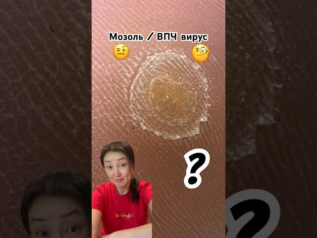 Что это ? #подолог #бородавки #мозоли