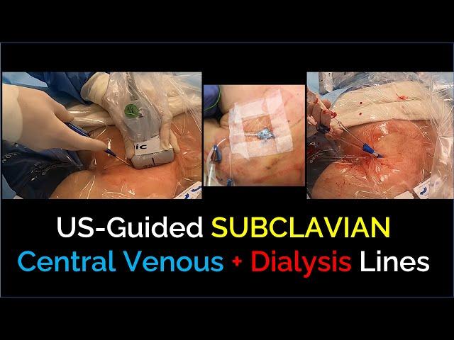 Ultrasound-Guided Subclavian Central Venous / Dialysis Line Insertion