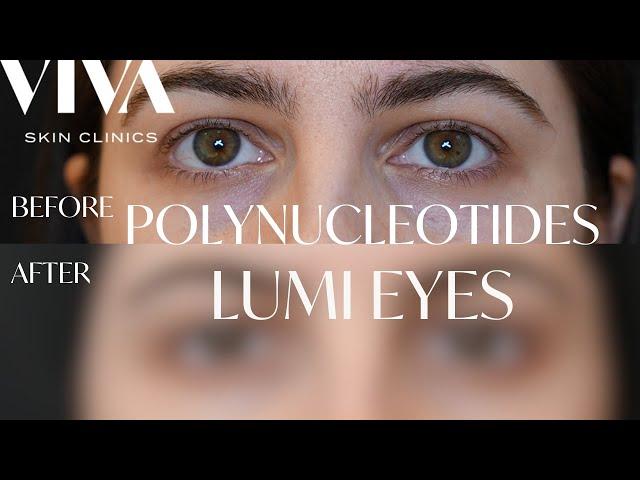 Lumi Eyes Polynucleotide PN  Injections 2024 | Before and Afters | Treat Dark Circles with Lumi Eyes