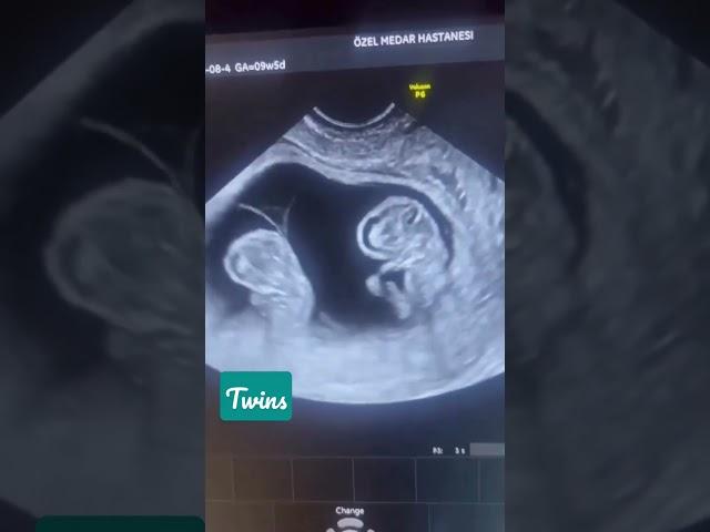 Ultrasound Scan️Twins#shorts #youtube #live #subscribe #viral #video #funny #twins#newborn#baby