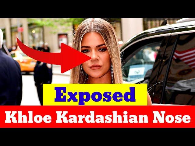 Khloe Kardashian Exposes Her ‘Collapsed’ Nose | Celebrities News Today | Hollywood News Today