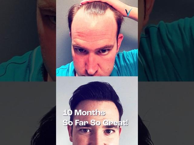 Month By Month Hair Transplant Result Turkey 4475 Grafts Sapphire FUE #hairtransplantturkey