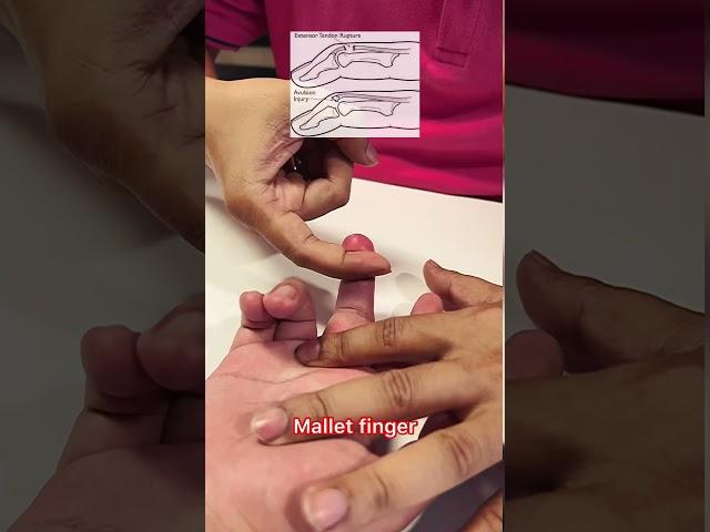 "Road to Recovery: Healing Mallet Finger with Effective Physiotherapy Treatment"