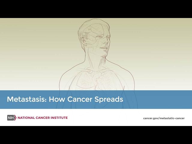 Metastasis: How Cancer Spreads