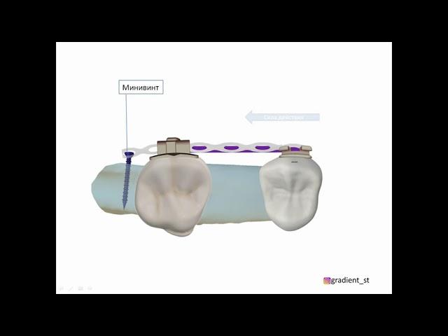 Минивинты в ортодонтии