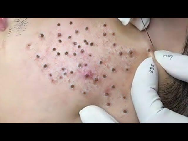 Relaxing Acne Treatment Everyday With Vu Quynh Mi Spa Blackheads Removal  Cystic Removal 2023  #008