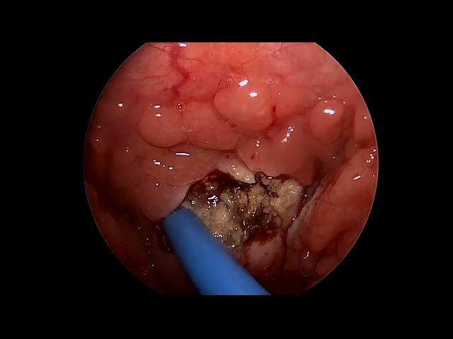 Adenoidectomy