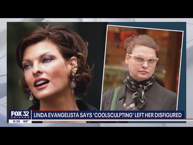 Supermodel Linda Evangelista files lawsuit against 'CoolSculpting' company