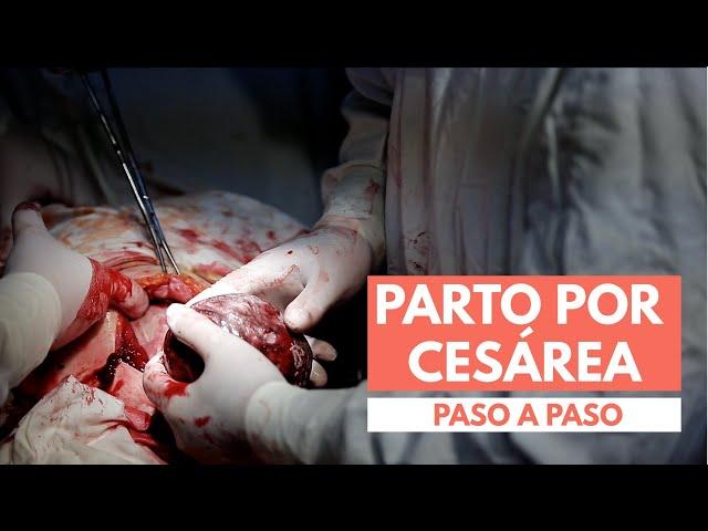 Parto Por Cesárea | Paso A Paso