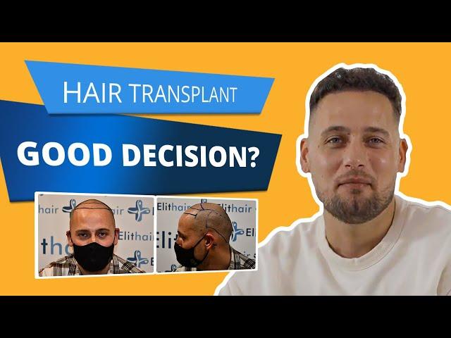 HAIR Transplant Turkey Experience I Elithair