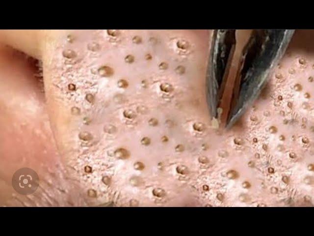 Facial care. EXTRACTION OF BLACK DOTS #рекомендации #уход