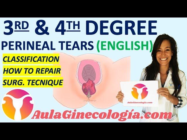 HOW TO REPAIR THIRD AND FOURTH DEGREE PERINEAL TEAR: SURGICAL TECNIQUE. - Gynecology and Obstetrics