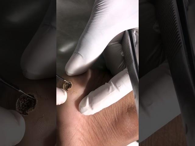 Warts Removal Treatment | Safe and Effective Wart Removal Treatment | Skinaa Clinic #viral #ytshorts