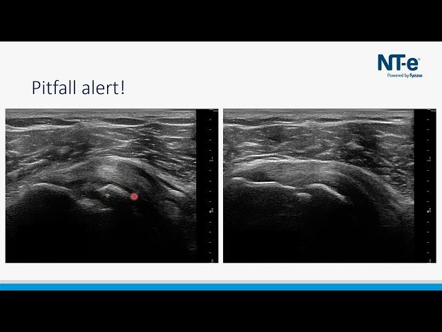 Valkuilen echografie van de schouder - calcificaties