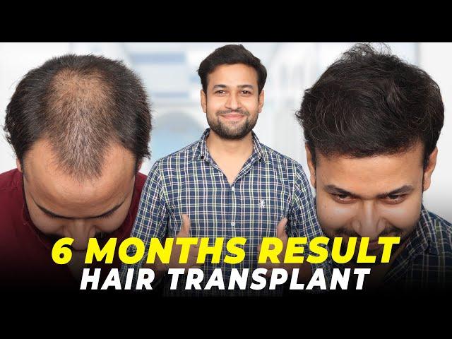 Hair Transplant in Delhi | Best Results & Cost of Hair Transplant in Delhi