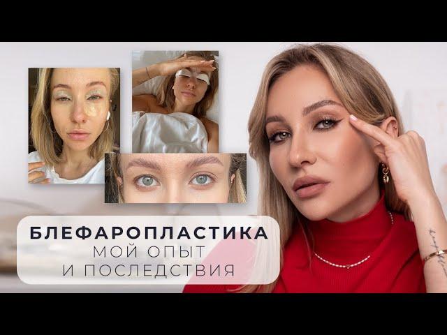 БЛЕФАРОПЛАСТИКА | ПОСМОТРИ ПРЕЖДЕ, ЧЕМ СДЕЛАТЬ!