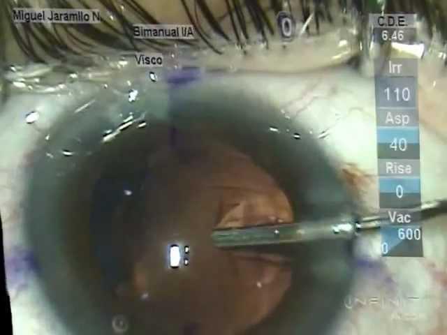 Operacion Ocular Jorge Bolivar