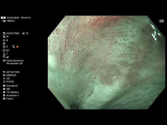 Squamous Cell Carcinoma -using NBI and TXI with Lugol for delineation