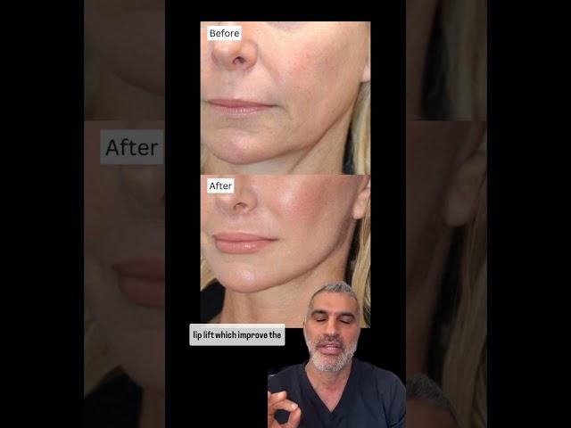 How to Get NATURAL Facelift Results!