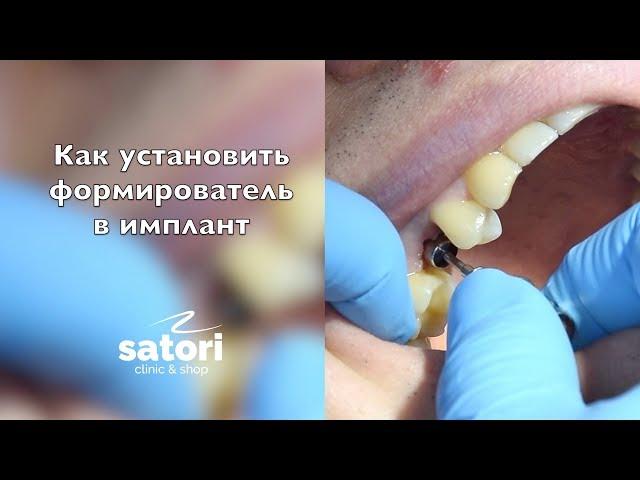 Как установить формирователь десны? Имплантация зубов Самара.