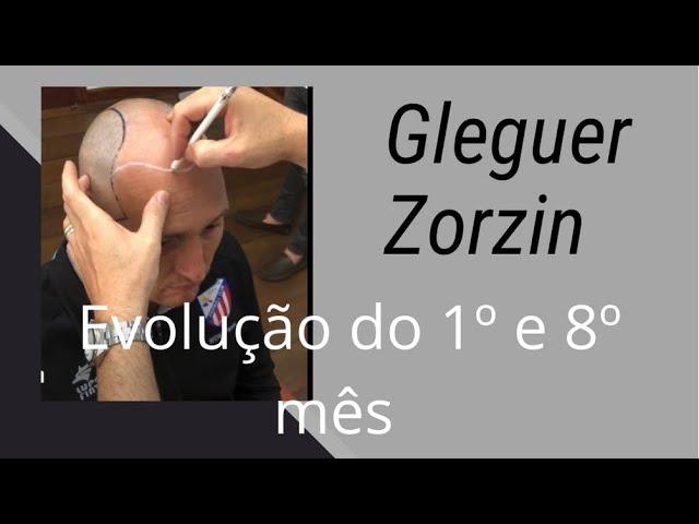 Ex GOLEIRO CORINTHIANS - GLEGUER ZORZIN. 8 meses após transplante capilar.