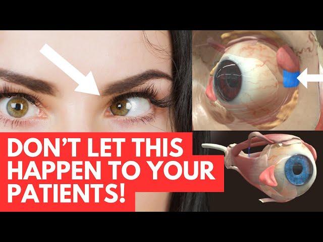 3-Minute Guide: Botox Injection Tips to Avoid Double Vision Complications