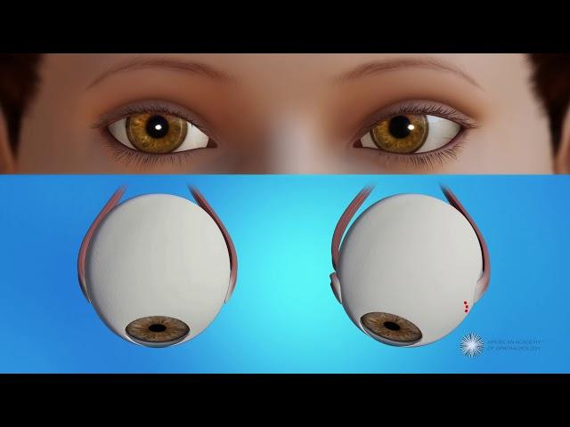 How is strabismus surgery done?