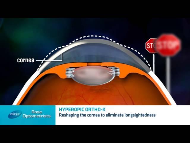 Long-sighted Ortho-keratology - Can long sighted people have Orthokeratology? Rose Optometrists