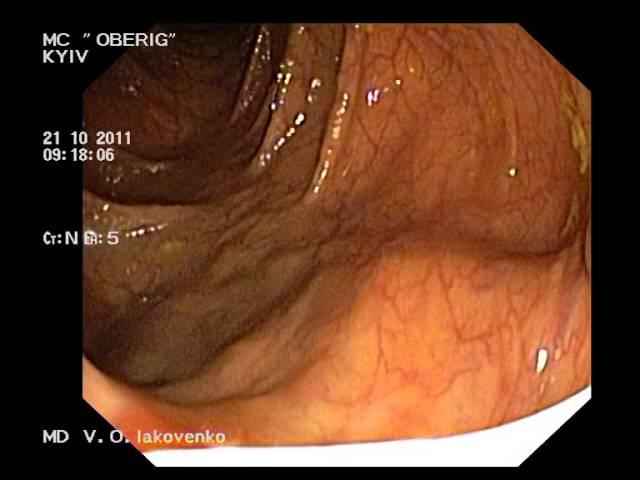 Ascaridosis on colonoscopy. Аскариды при колоноскопии