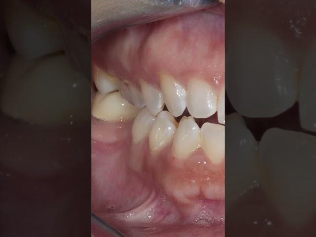 Porcelain Veneers Before and After