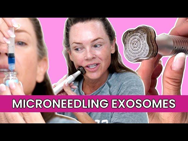 Can Microneedling With Exosomes Erase Wrinkles?