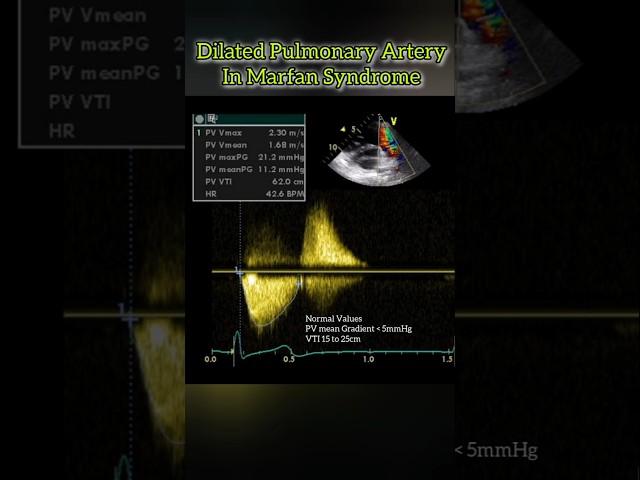 Dilated Pulmonary Artery in Marfan Syndrome #heart #cardiology #echocardiography #shorts #reels