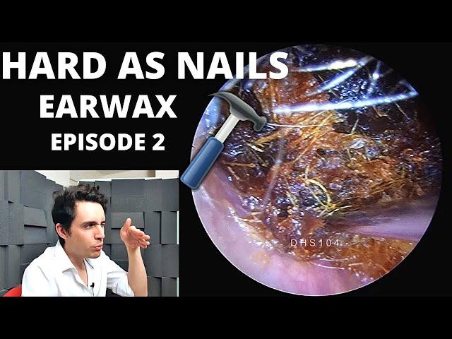 Hard As Nails Ear Wax EPISODE 2