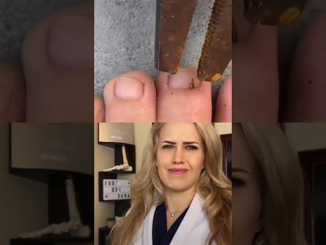 #Doctor reacts: HUGE splinter removal