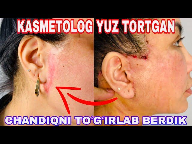 KASMETOLOGDAN QOLGAN CHANDIQNI TOʻGʻIRLAB BERDIK | YUZ TORTISH | ЮЗ ТОРТИШ #2024