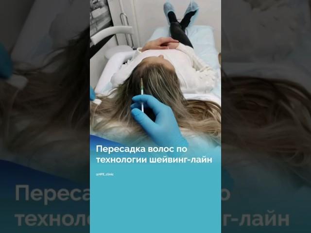 Пересадка волос без обривания! #пересадкаволосмосква #клиникаHFE