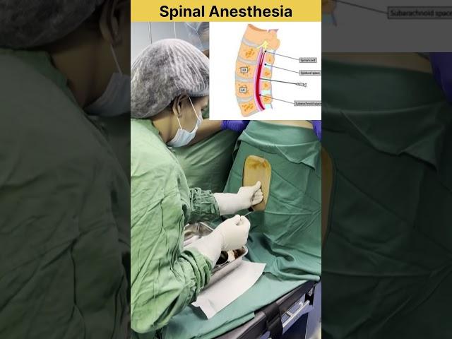 Spinal Anesthesia Procedure #doctor #mbbs #anesthesia #neet #medical #medicalstudent #medico #short